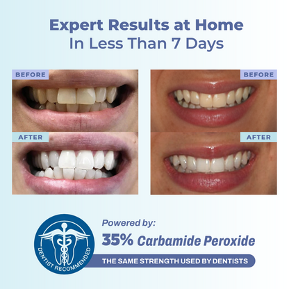 Smile Nova™ Advanced White Teeth Whitening Gel Refill Pack | 3X 10 mL Dental-Grade Gel Syringes | 60 Treatments, Professional 35% Carbamide Peroxide, | Restore+ Nano-Hydroxyapatite Toothpaste